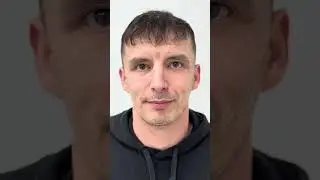 12 luni de la operația de Blefaroplastie la Clinica Dr. Levy Medical Center din București