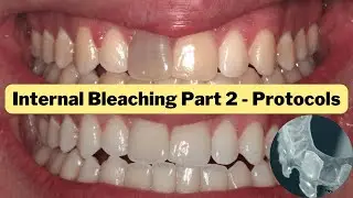 Internal Whitening Protocols Part 2 (Non Vital Bleaching) - PDP147