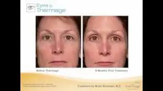 Eyelift Without Surgery Brisbane - Thermage NXT