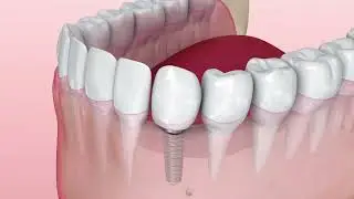 Dental Implants Are the #1 Tooth Loss Treatment