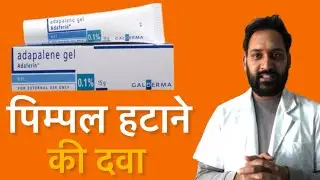 How to Use Adaferin Gel | Adapalene Gel Review in Hindi | The Right Way to Treat Pimples and Acne