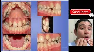 Hablemos de Ortodoncia: Pacientes Clase III y Uso de un Expansor Palatino.