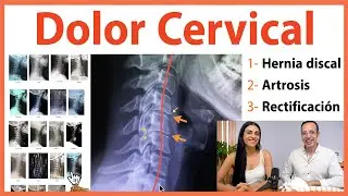 🔴 Dolor Cervical | HERNIA DISCAL, RECTIFICACIÓN y ARTROSIS 👉 Causas ocultas para el Yoga y Pilates