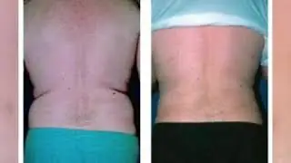 Amazing Body Liposuction Results by Dr. Thomas Barnes, Newport Beach Cosmetic Surgeon!