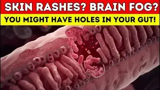 Skin Rashes? Brain Fog? You Might Have Holes in Your Gut! | 3-Step Protocol Doctors Don't Tell You
