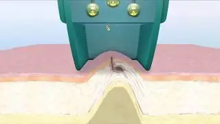 Blackhead Vacuum Pore Cleaner&trade;