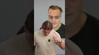 Life-Changing Robotic DHI Hair Transplant | Este Medical Results