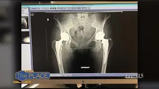 Hip replacement in younger patients