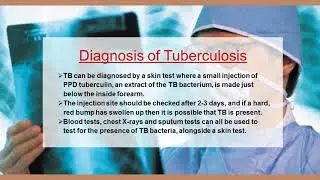 All you need to know about Tuberculosis | Dr  Dangs lab