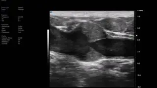 UHJ 48 MHz - Arm Vein with Valve