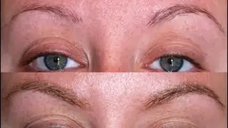Eyebrow Hairloss and Restoration by Northwest Hair Restoration