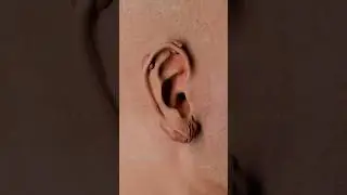 How keloid scars appear: the impact of piercings visualized in 3D