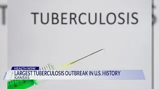 Largest documented tuberculosis outbreak in US history hits Kansas