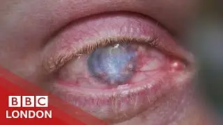 How an Acid Attack survivor regained his sight - BBC London