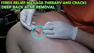 ASMR BARBER DEEP BACK ACNE REMOVAL AND MASSAGE 💈 CRACKS 💈 STRESS RELIEF UPPER BODY MASSAGE FOR YOU