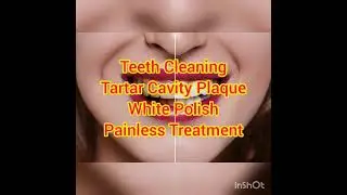 Teeth Cleaning Scaling Tartar Cavity Plaque Polish Painless Treatment Prabh Dental Care Amritsar