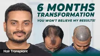 FUE Hair Transplant Results | Best Cost & Results of FUE Hair Transplant