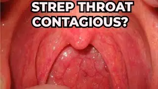 Is Strep Throat Contagious? Everything You Need to Know!