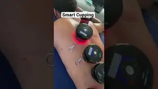 Smart Cupping with Achedaway Cupper. #cuppingtherapy #cupping #backpainrelief