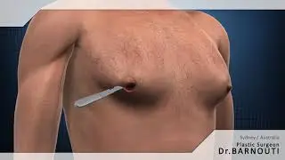 Dr Barnouti,  Gynecomastia surgery  in Sydney