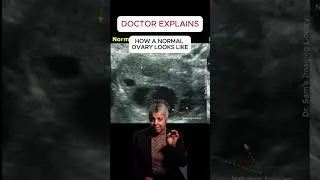 Doctor explains polycystic ovaries
