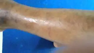 Snake bite marks