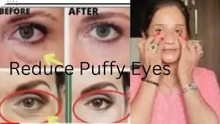 Reduce Puffy Eyes,Eye Wrinkles,Dark Circles, आखों के नीचे की सूजन को खत्म करे सिर्फ दो exercise से😊