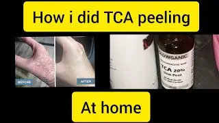 How i did TCA peeling at home #skinpeel #peeling #skincare  #skinpeel