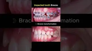 Braces transformation. impacted and crooked teeth treatment #braces #dentist