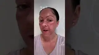 Windyigarn Spicule BioMicroneedling Kit Day 1 - Amazing Results By Nature