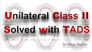 Invisalign and TADS to solve a Severe Class II Malocclusion