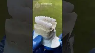The Royal Standard of Beauty for Your Teeth 👑 #dentalcrowns