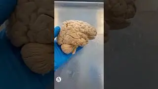 Right Hemisphere &ndash; Parietal Lobe #anatomy #medicalstudents