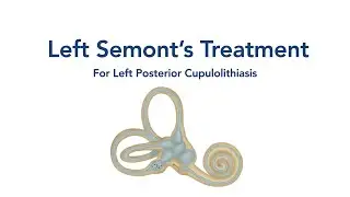 At Home Left Semont's Treatment for BPPV Vertigo