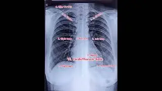 How to read Chest Xray full information।। #xray #xraytechnician #studymotivation #cardio #radiology
