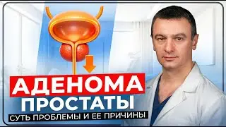 Аденома простаты. Почему появляется и что собой представляет?
