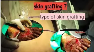 #skin grafting and  type of skin grafting