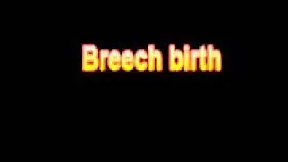 What Is The Definition Of Breech birth Medical Dictionary Free Online