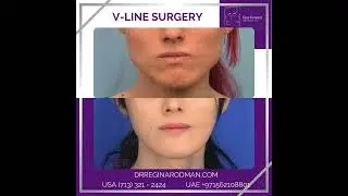 V Line Surgery