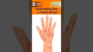 SKIN PEELING from Hand & Feet-Is it Eczema, Psoriasis,Fungus?-Dr.Rasya Dixit|Doctors' Circle #shorts