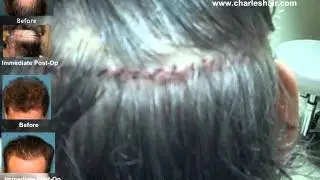 FUG Hair Transplant for 52-yr-old patient (2058 Grafts)in Boca Raton | Charles Medical Group Video