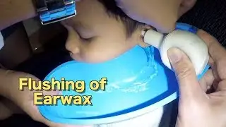 3 Year Old Boy's Flushing of Earwax