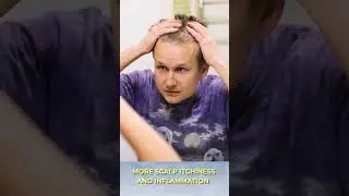 Яблочный уксус усиливает выпадение волос? Иногда.