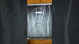 Nic 2020 MRI Lumbar; L3-L4, L4-L5, L5-S1