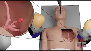 Tiny robot can travel deep into lungs to detect and treat cancer