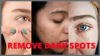 How To Remove Pimples and Dark Spots Overnight  | Safe Pimple and Acne Treatments (Home Remedies)