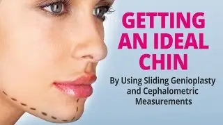 Getting An Ideal Chin By Using Sliding Genioplasty and Cephalometric Measurements