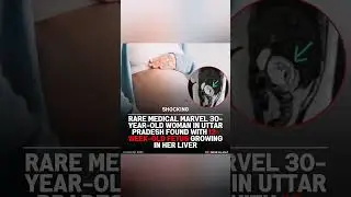 RARE MEDICAL MARVEL 30- YEAR WOMAN IN UTTAR PRADESH FOUND WITH 12 WEEK-OLD FETUS GROWING IN LIVER