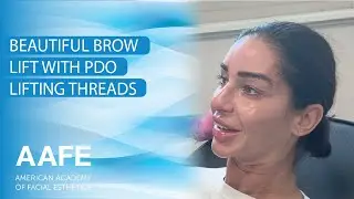 Красивая подтяжка бровей с помощью нитей PDO