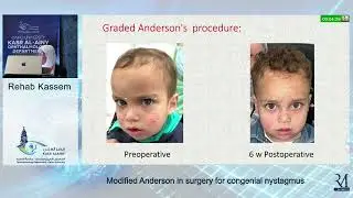 Annual Conference 2023 - Modified Anderson's Procedure for Infantile Nystagmus - Prof. Rehab Kassem